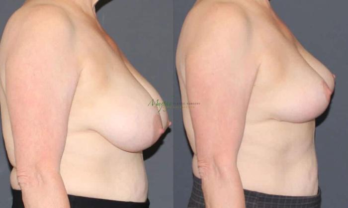 Before & After Breast Reduction Case 89 Right Side View in Denver, Colorado