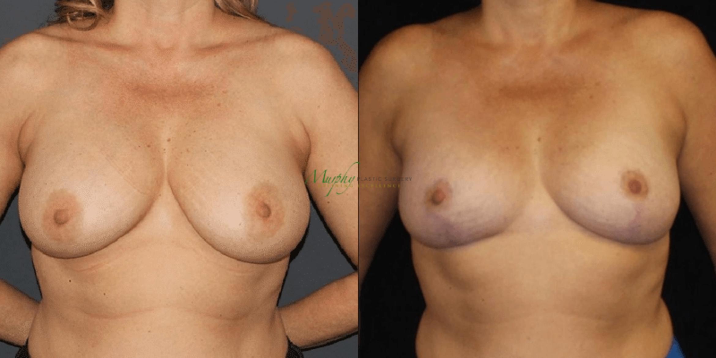 Before & After Breast Reduction Case 90 Front View in Denver, Colorado