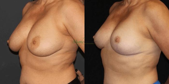 Before & After Breast Reduction Case 90 Left Oblique View in Denver, Colorado