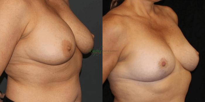 Before & After Breast Reduction Case 90 Right Oblique View in Denver, Colorado