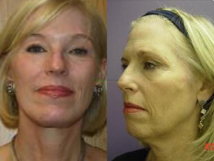 Before & After Brows and Eyes Case 117 Front View in Denver, Colorado