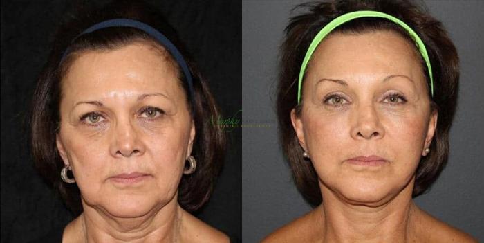 Before & After Brows and Eyes Case 12 Front View in Denver, Colorado