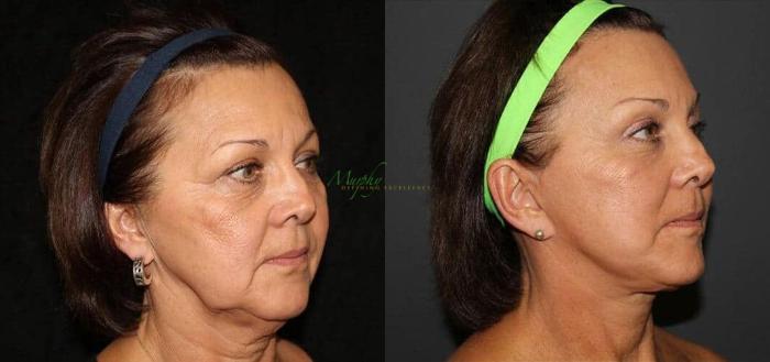 Before & After Brows and Eyes Case 12 Right Oblique View in Denver, Colorado