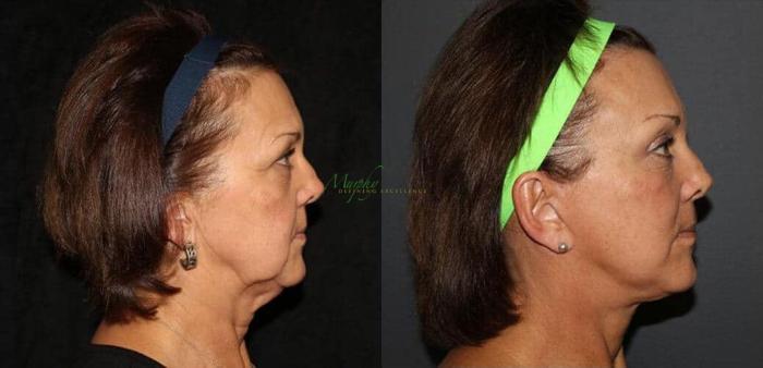 Before & After Brows and Eyes Case 12 Right Side View in Denver, Colorado