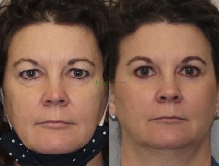 Before & After Brows and Eyes Case 120 Front View in Denver, Colorado