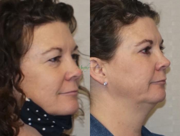 Before & After Brows and Eyes Case 120 Left Oblique View in Denver, Colorado