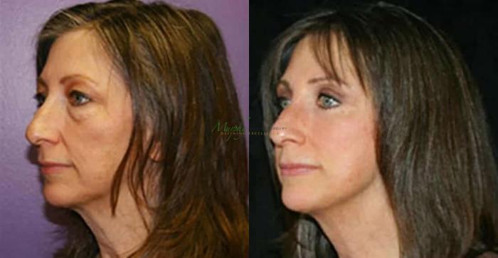 Before & After Brows and Eyes Case 13 Left Oblique View in Denver, Colorado