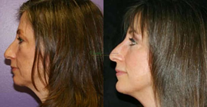 Before & After Brows and Eyes Case 13 Left Side View in Denver, Colorado