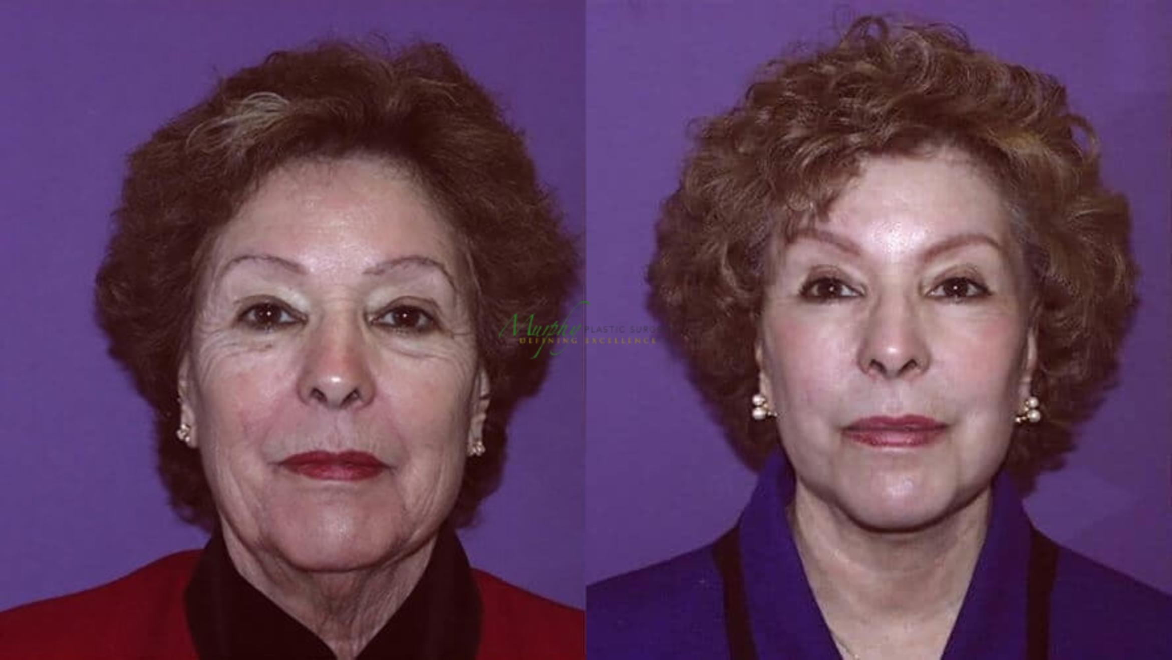 Before & After Brows and Eyes Case 16 Front View in Denver, Colorado