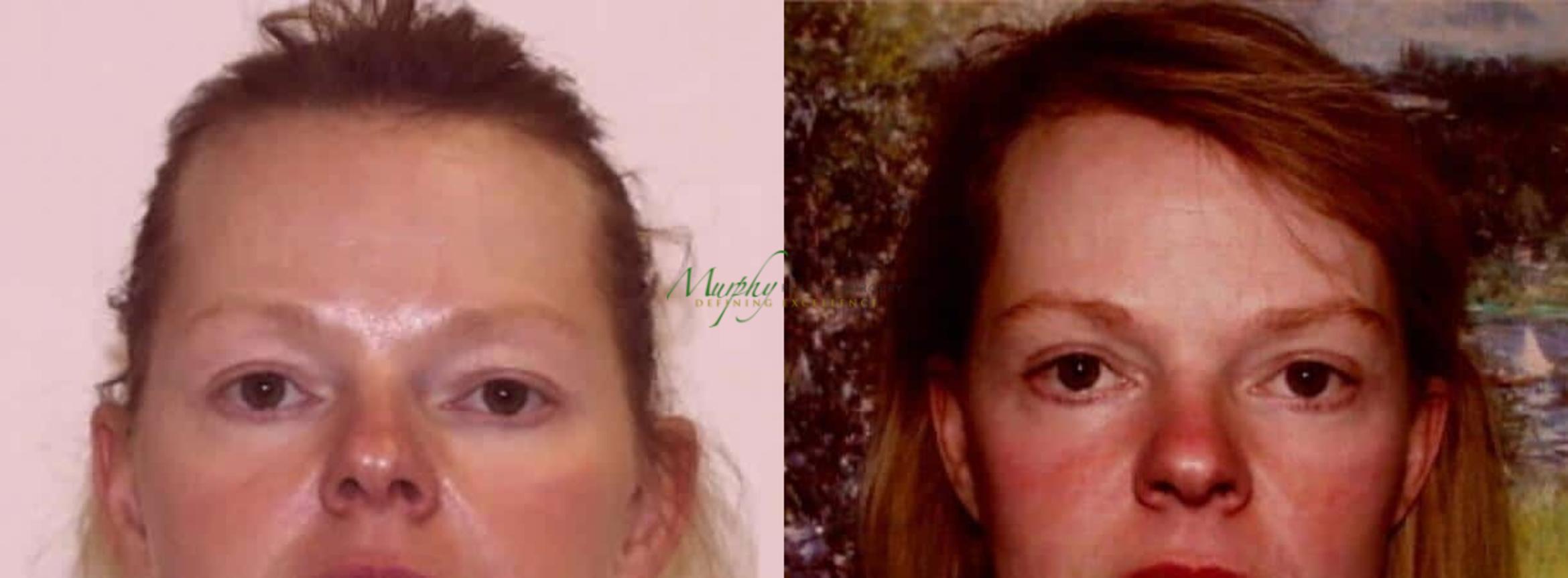 Before & After Brows and Eyes Case 17 Front View in Denver, Colorado