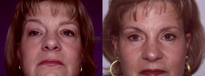 Before & After Brows and Eyes Case 18 Front View in Denver, Colorado