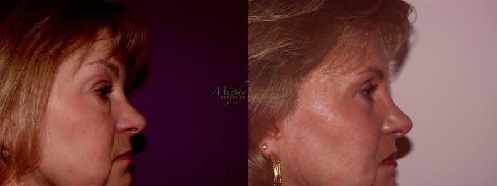 Before & After Brows and Eyes Case 18 Right Side View in Denver, Colorado