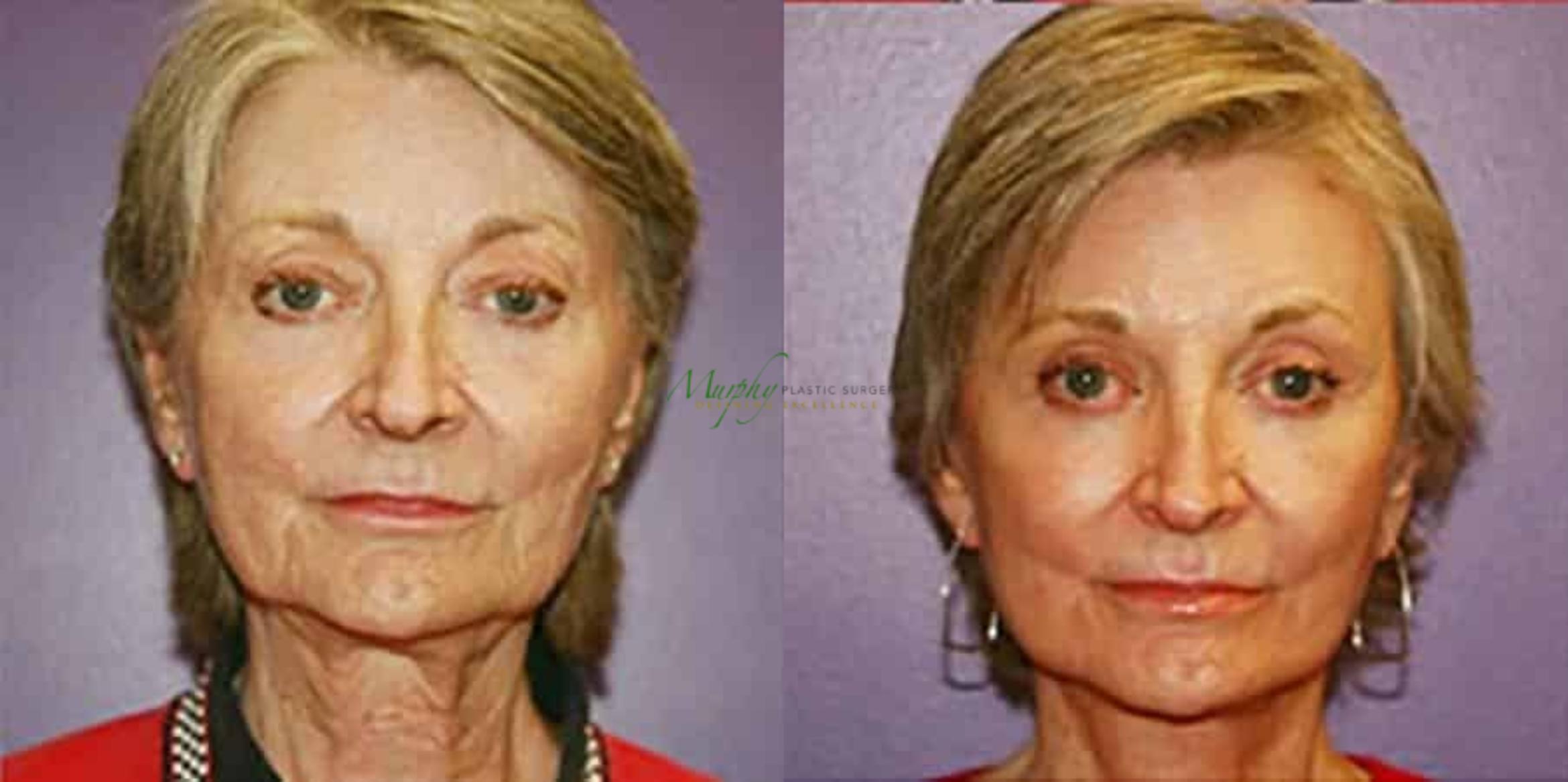 Before & After Brows and Eyes Case 21 Front View in Denver, Colorado