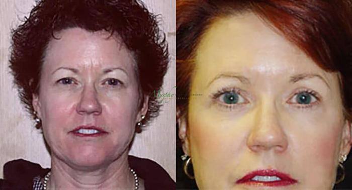 Before & After Brows and Eyes Case 22 Front View in Denver, Colorado