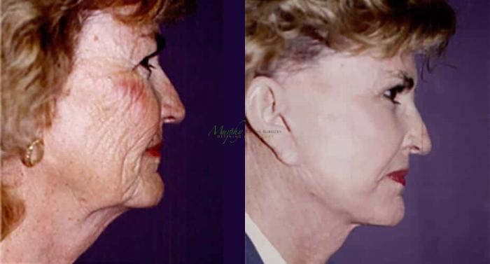 Before & After Brows and Eyes Case 23 Right Side View in Denver, Colorado