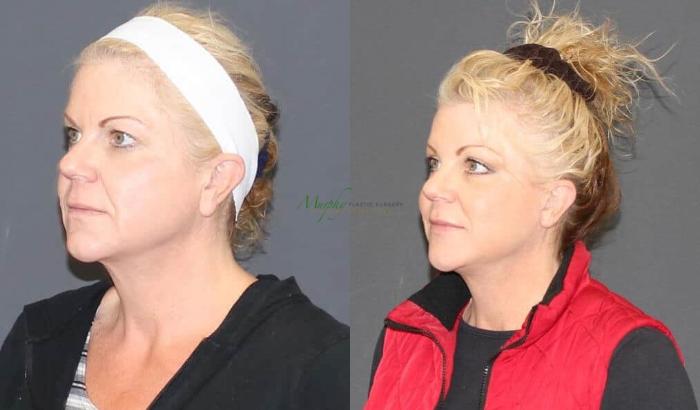 Before & After Brows and Eyes Case 24 Left Oblique View in Denver, Colorado