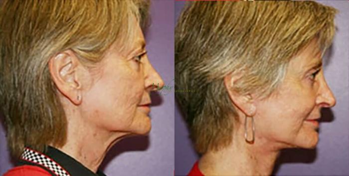 Before & After Facelift Case 10 Right Side View in Denver, Colorado