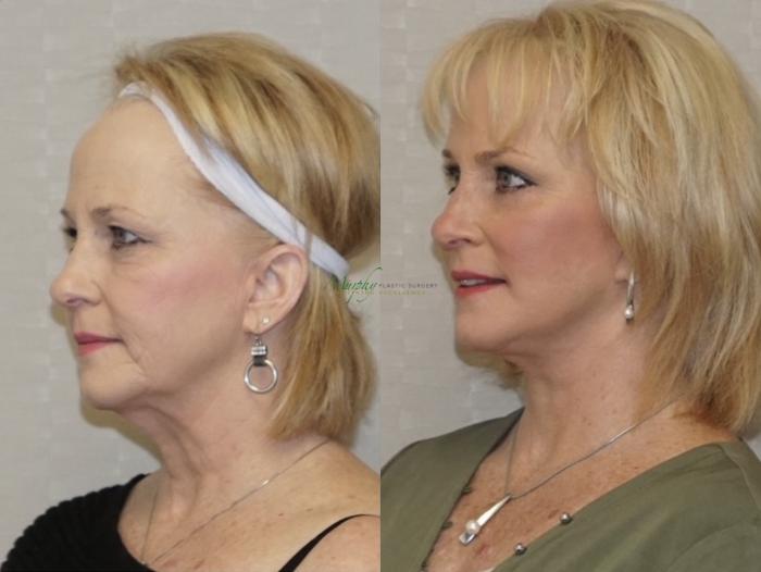 Before & After Brows and Eyes Case 108 Left Oblique View in Denver, Colorado