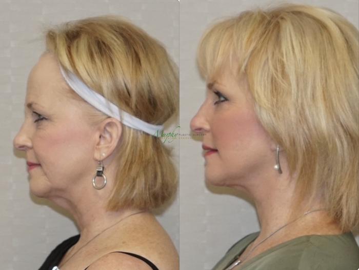 Before & After Brows and Eyes Case 108 Left Side View in Denver, Colorado