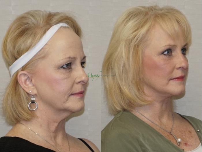 Before & After Facelift Case 108 Right Oblique View in Denver, Colorado