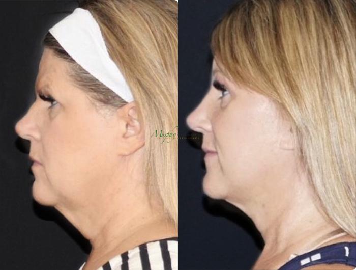 Before & After Facelift Case 109 Right Side View in Denver, Colorado