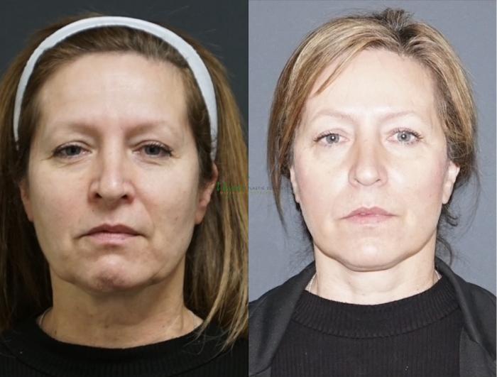 Before & After Facelift Case 111 Front View in Denver, Colorado