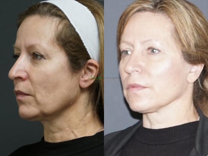 Before & After Facelift Case 111 Right Oblique View in Denver, Colorado