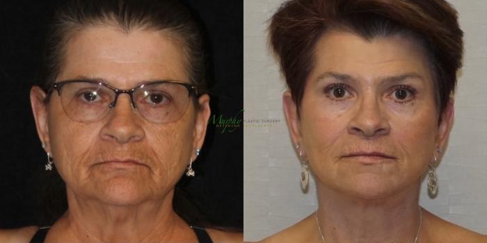 Before & After Facelift Case 113 Front View in Denver, Colorado