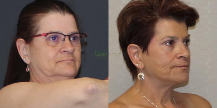 Before & After Brows and Eyes Case 113 Left Oblique View in Denver, Colorado