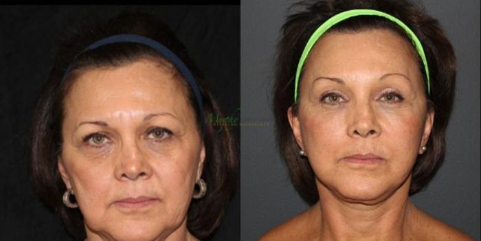 Before & After Facelift Case 115 Front View in Denver, Colorado