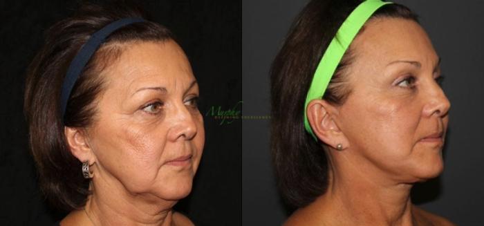 Before & After Brows and Eyes Case 115 Left Oblique View in Denver, Colorado