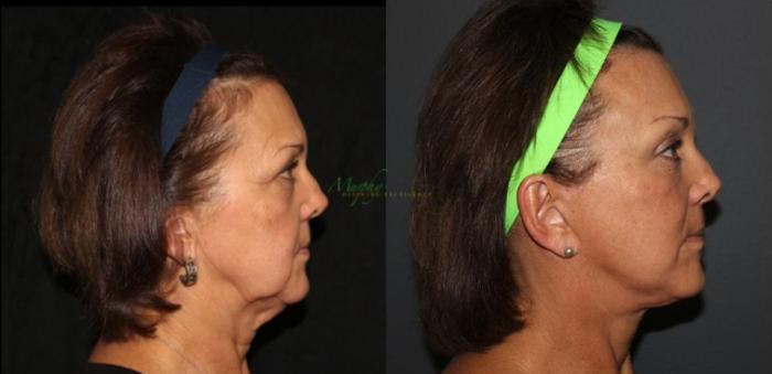 Before & After Brows and Eyes Case 115 Left Side View in Denver, Colorado