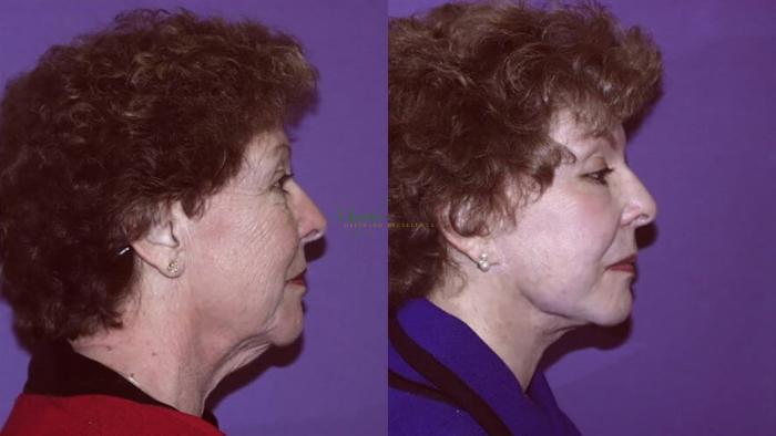 Before & After Facelift Case 8 Right Side View in Denver, Colorado