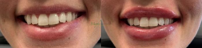 1 ml Juvederm Volbella Filler