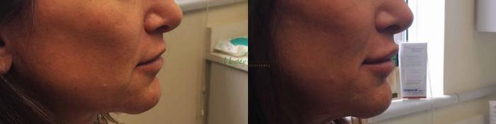 Before & After Filler Case 31 Right Side View in Denver, Colorado