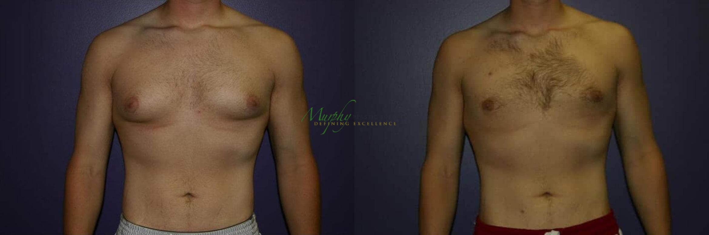 Before & After Gynecomastia Case 93 Front View in Denver, Colorado