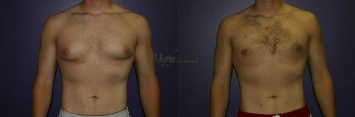 Before & After Gynecomastia Case 93 Front View in Denver, Colorado