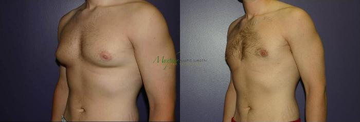 Before & After Gynecomastia Case 93 Left Oblique View in Denver, Colorado