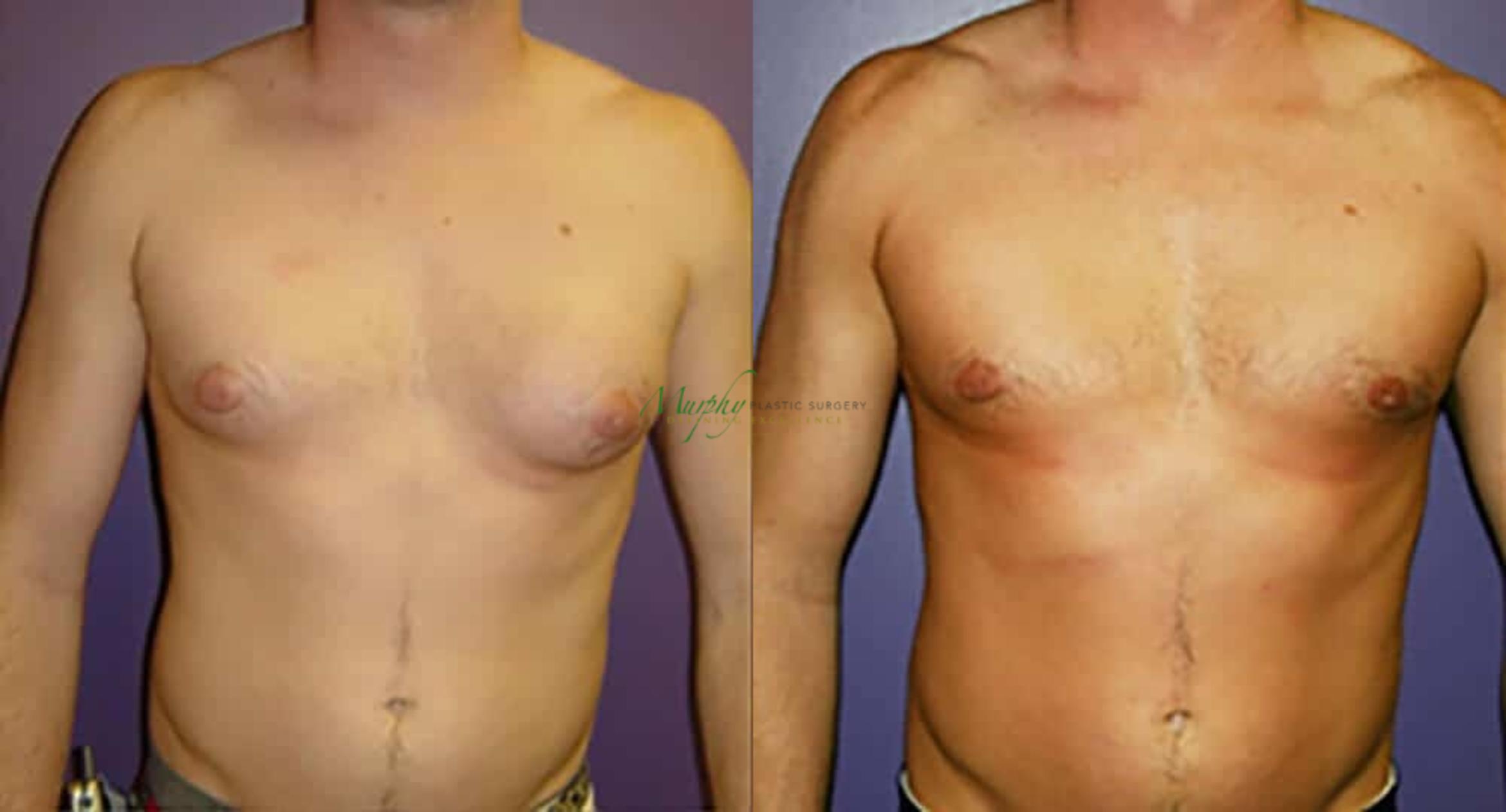 Before & After Gynecomastia Case 94 Front View in Denver, Colorado