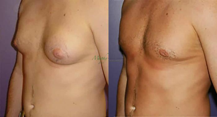 Before & After Gynecomastia Case 94 Left Oblique View in Denver, Colorado
