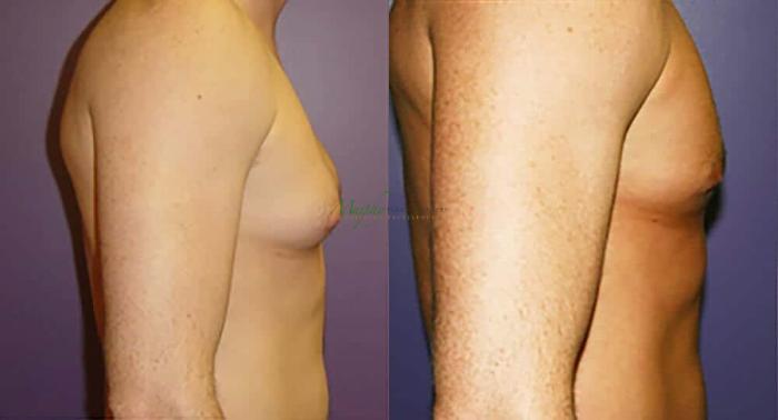 Before & After Gynecomastia Case 94 Right Side View in Denver, Colorado
