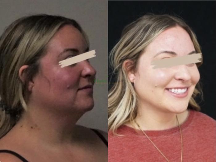 Before & After Liposuction Case 118 Left Oblique View in Denver, Colorado