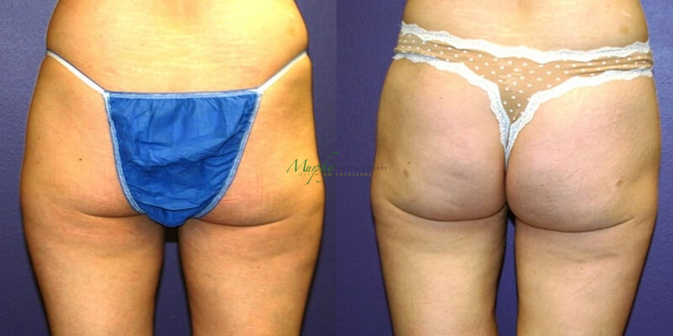 Before & After Liposuction Case 56 Back View in Denver, Colorado