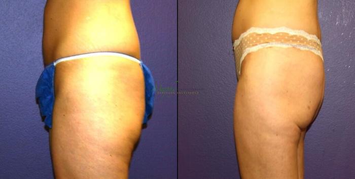 Before & After Liposuction Case 56 Left Side View in Denver, Colorado