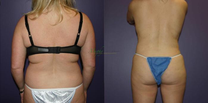 Before & After Liposuction Case 57 Back View in Denver, Colorado
