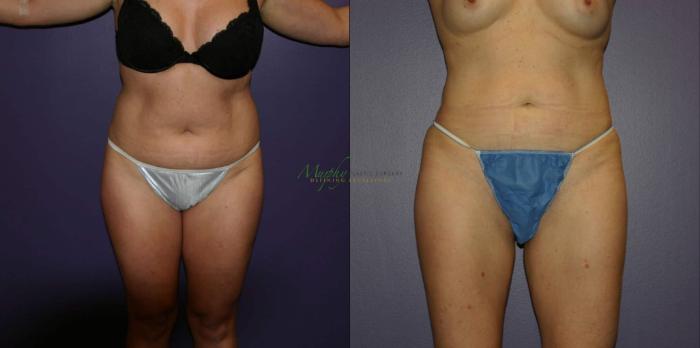 Before & After Liposuction Case 57 Front View in Denver, Colorado