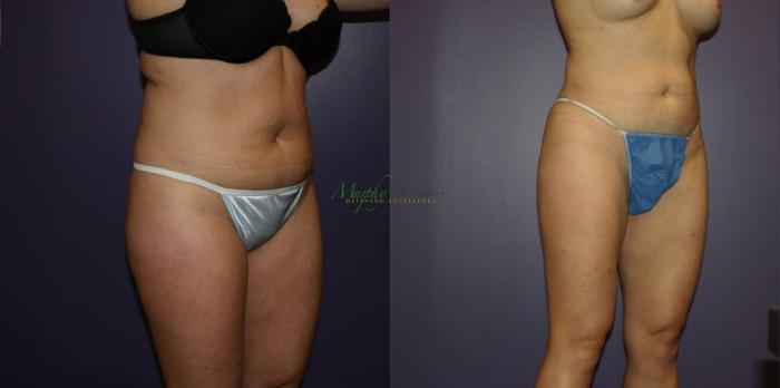 Before & After Liposuction Case 57 Right Oblique View in Denver, Colorado