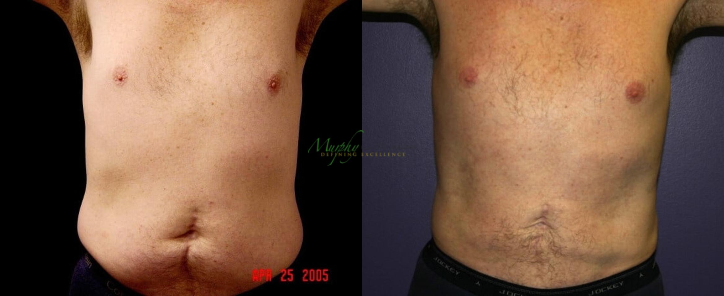 Before & After Liposuction Case 60 Front View in Denver, Colorado