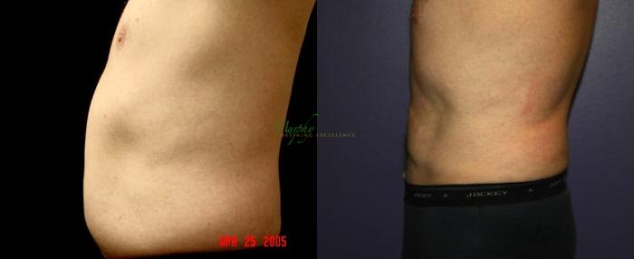 Before & After Liposuction Case 60 Left Side View in Denver, Colorado