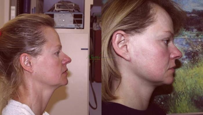 Before & After Mini Facelift Case 1 Right Side View in Denver, Colorado